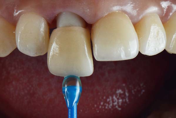 What To Do About A Loose Dental Crown